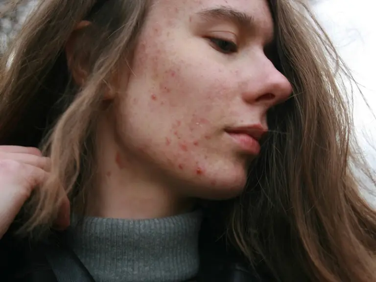 Junge Frau mit langen Haaren und Akne.